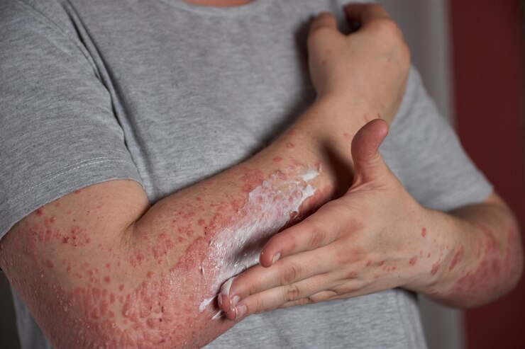 Overview of Bacterial Skin Infections