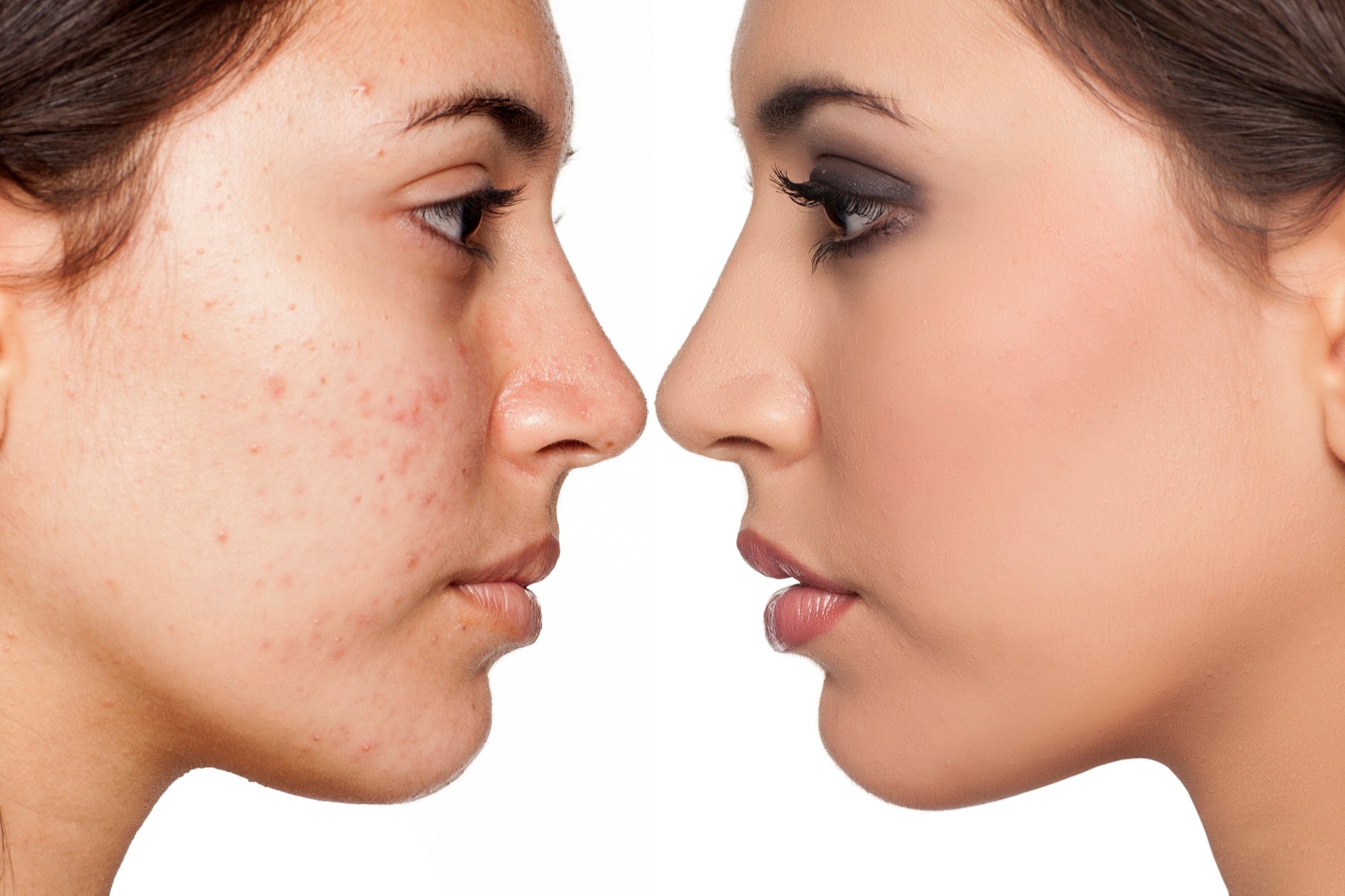 Can accutane tablets clear hormonal acne in adults?